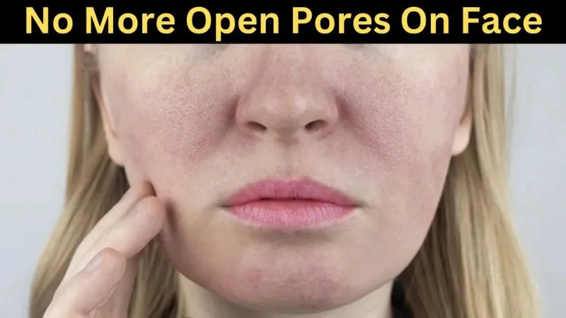 Cure Open Pores On Face